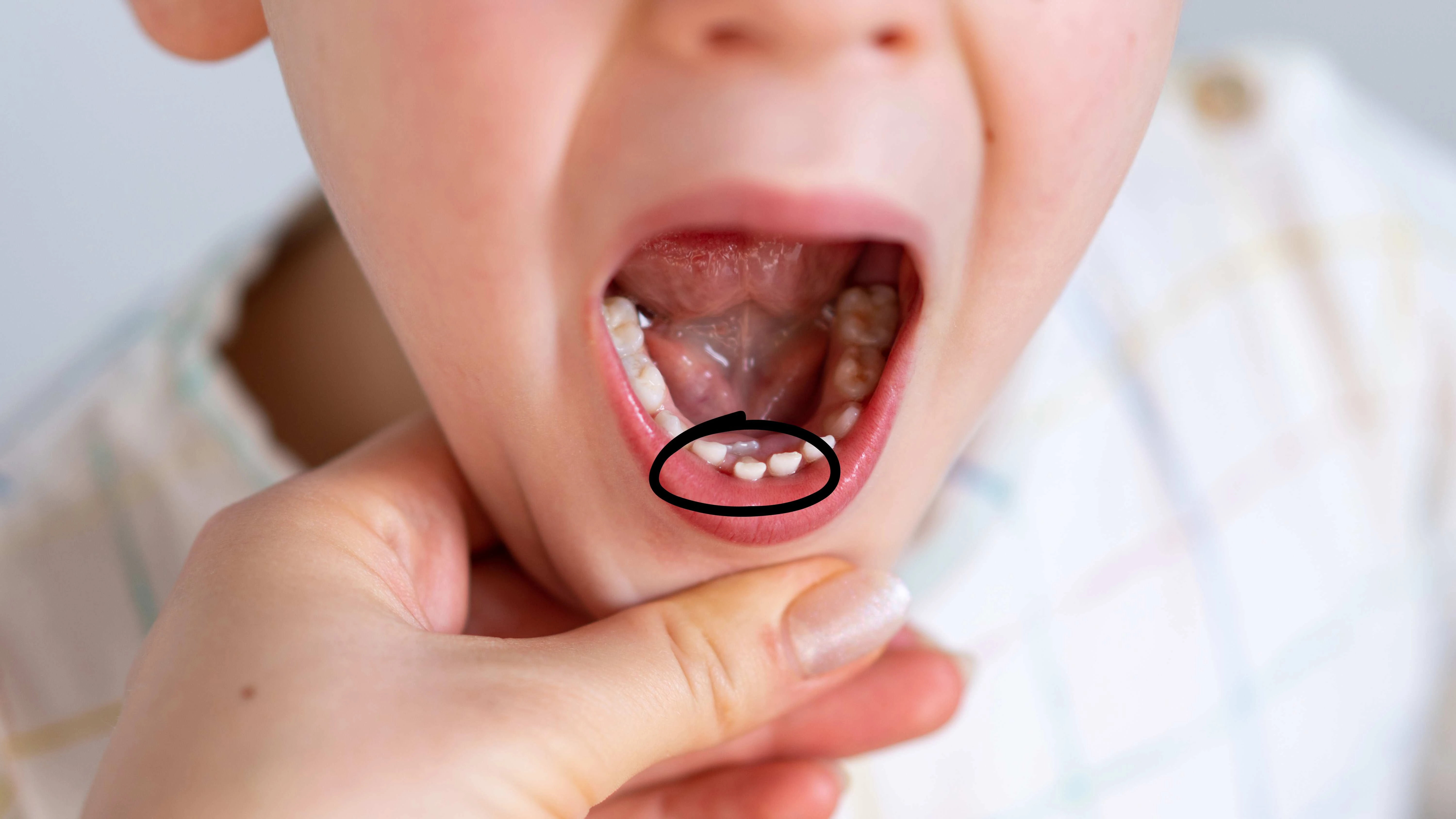 Close-up of a child’s mouth showing a permanent lower front tooth erupting behind a retained baby tooth, a condition commonly known as shark teeth.