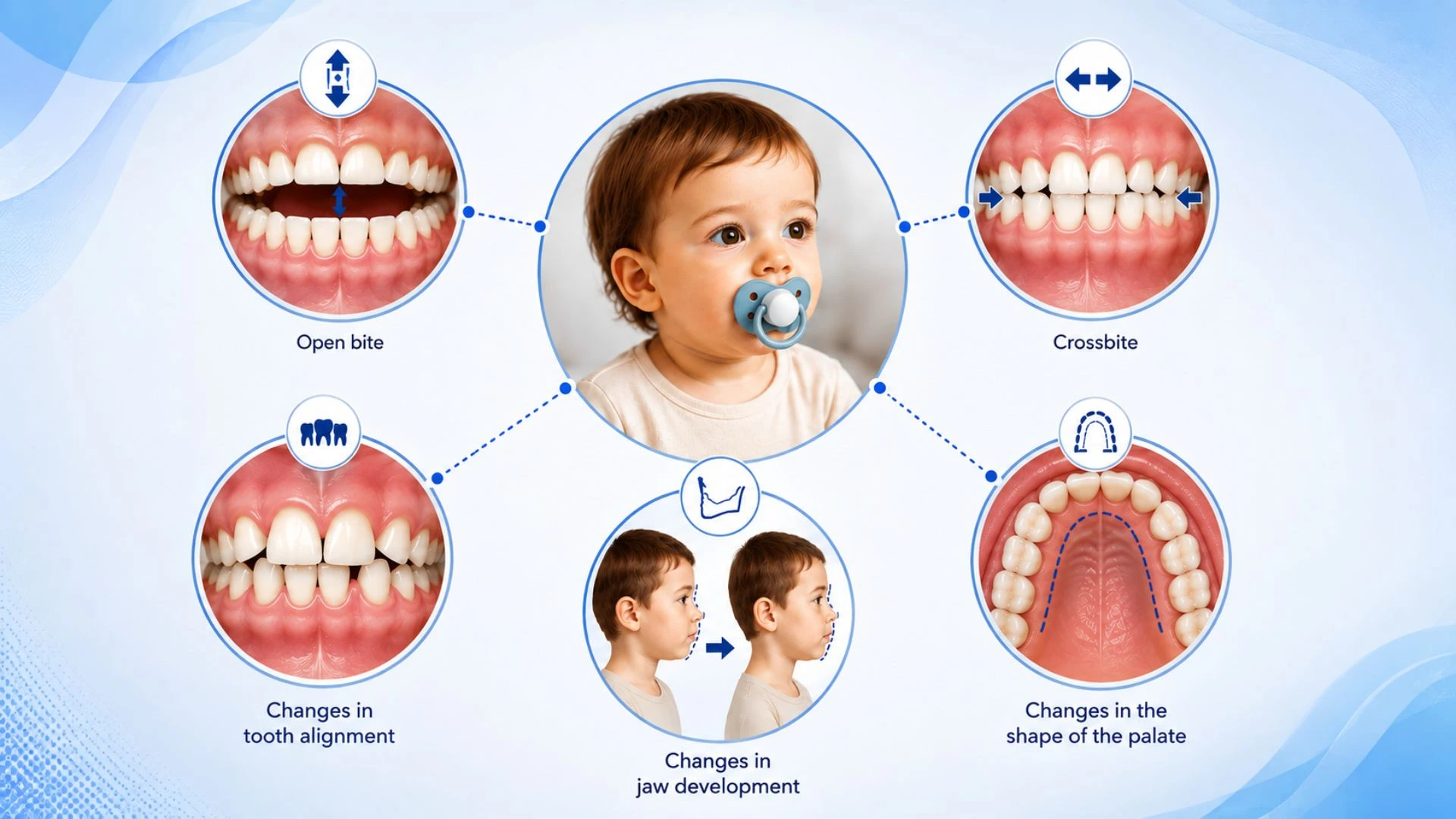 Infographic showing pacifier-related open bite, crossbite, tooth alignment, jaw, and palate changes in children.
