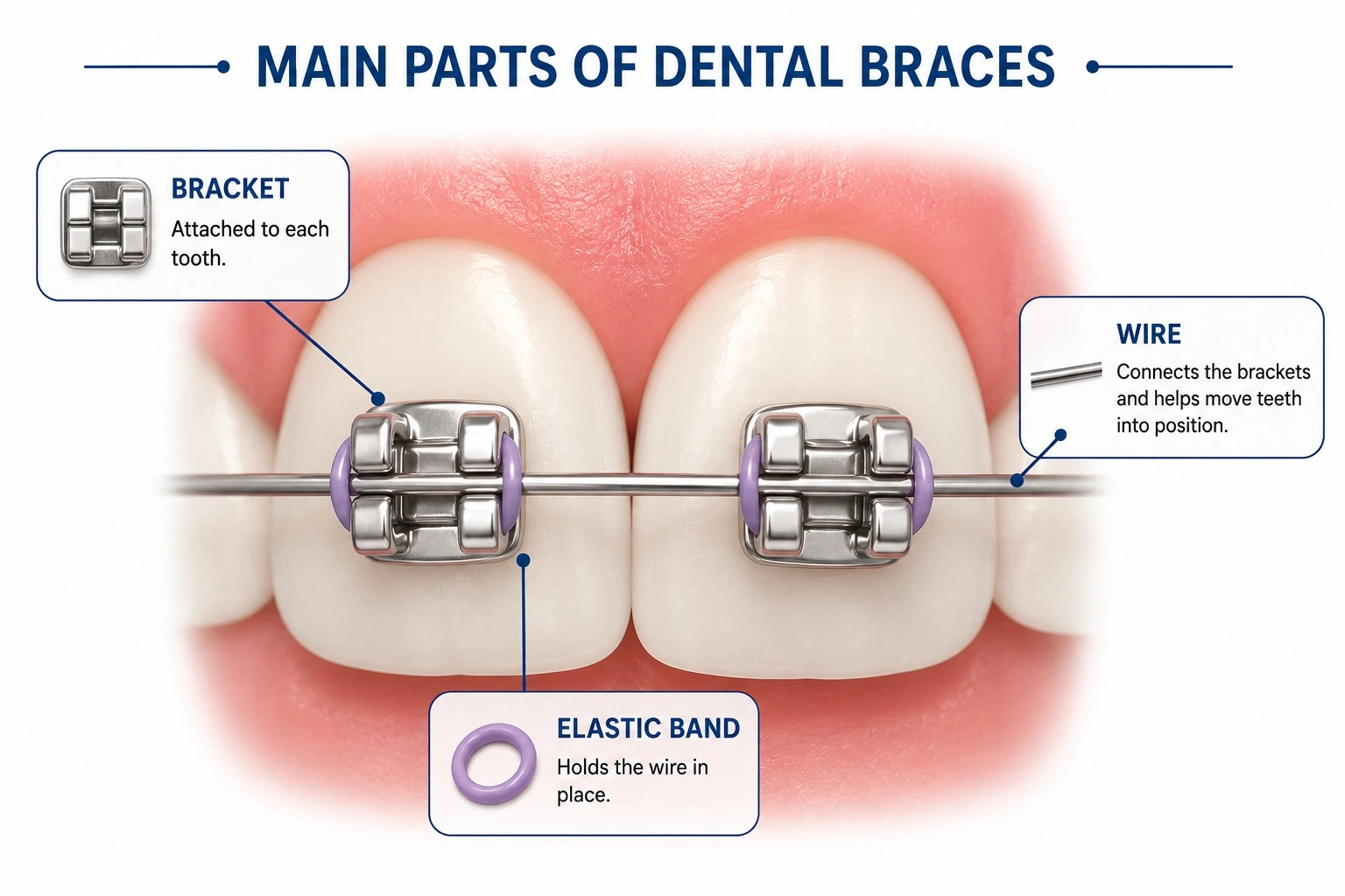 Illustration of dental braces showing brackets, wire, and elastic bands used in orthodontic treatment.