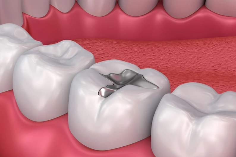 Dental Filling Illustration