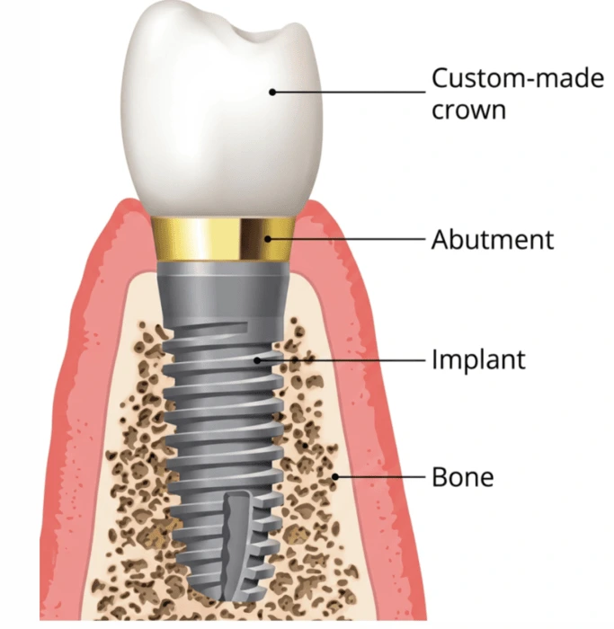 Diagram showing the parts of a dental implant, including the crown, abutment, implant, and jawbone