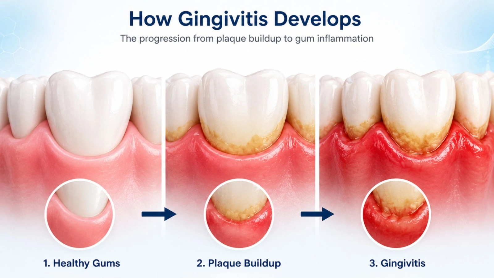 Healthy gums, plaque buildup, and gingivitis illustration.