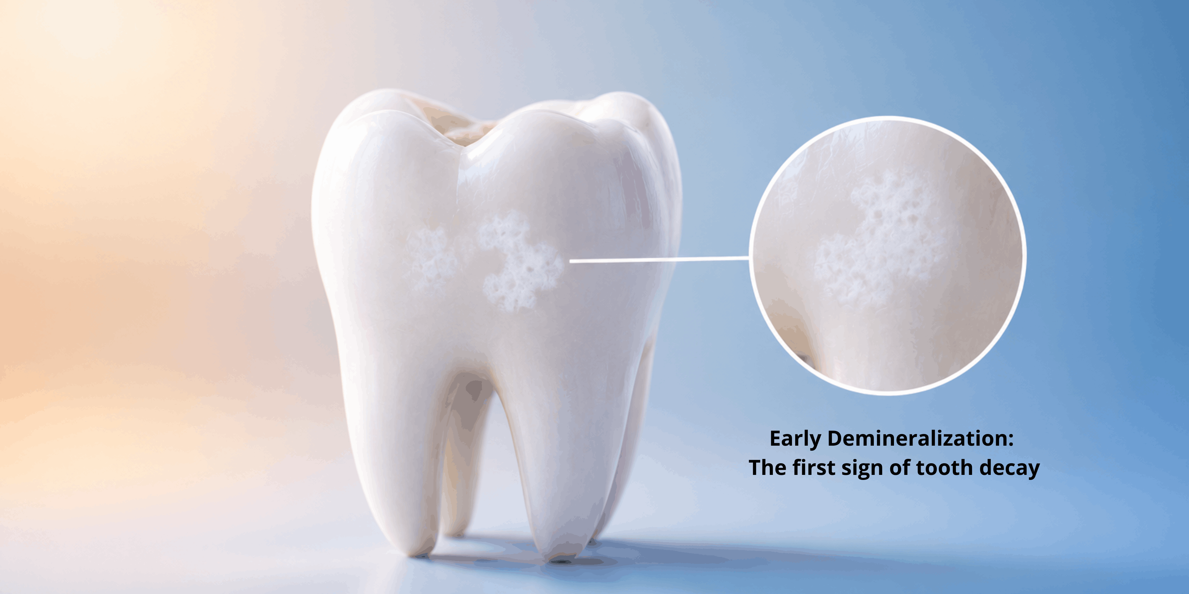 Tooth showing a white spot lesion indicating early enamel demineralization.