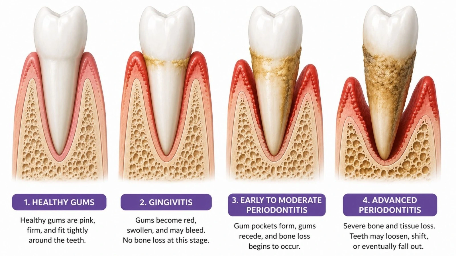 Stages of periodontal disease showing healthy gums, gingivitis, early periodontitis, and advanced periodontitis.               