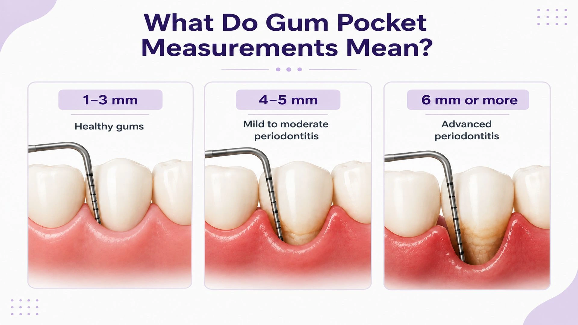 Gum pocket depth illustration showing healthy gums, moderate periodontitis, and advanced periodontitis.