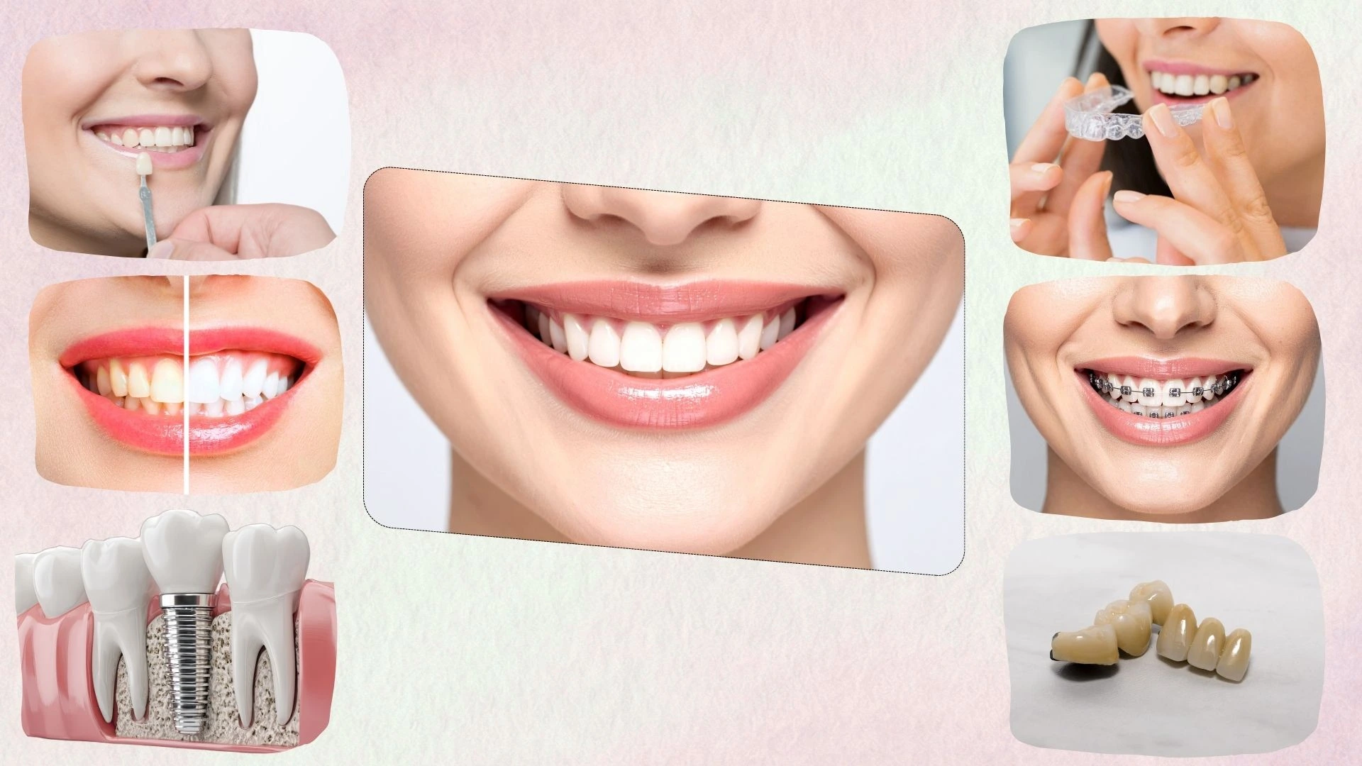 Collage showing different smile makeover treatments, including veneers, teeth whitening, clear aligners, braces, dental implants, and dental crowns.