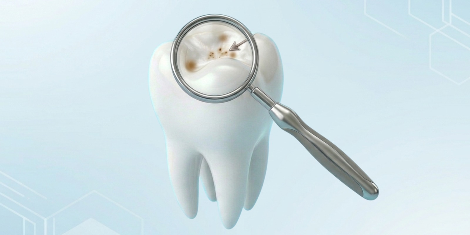 Close-up image of cavities and early tooth decay showing enamel damage, dark spots, and dental caries on a tooth surface.