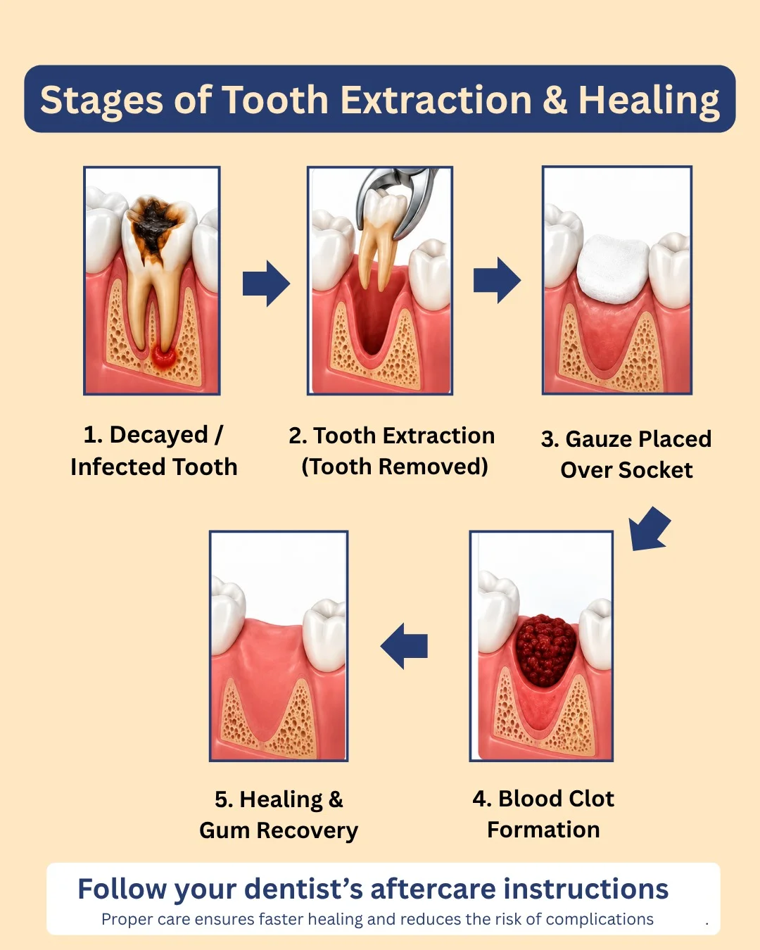 Dental tooth extraction procedure being performed by dentist