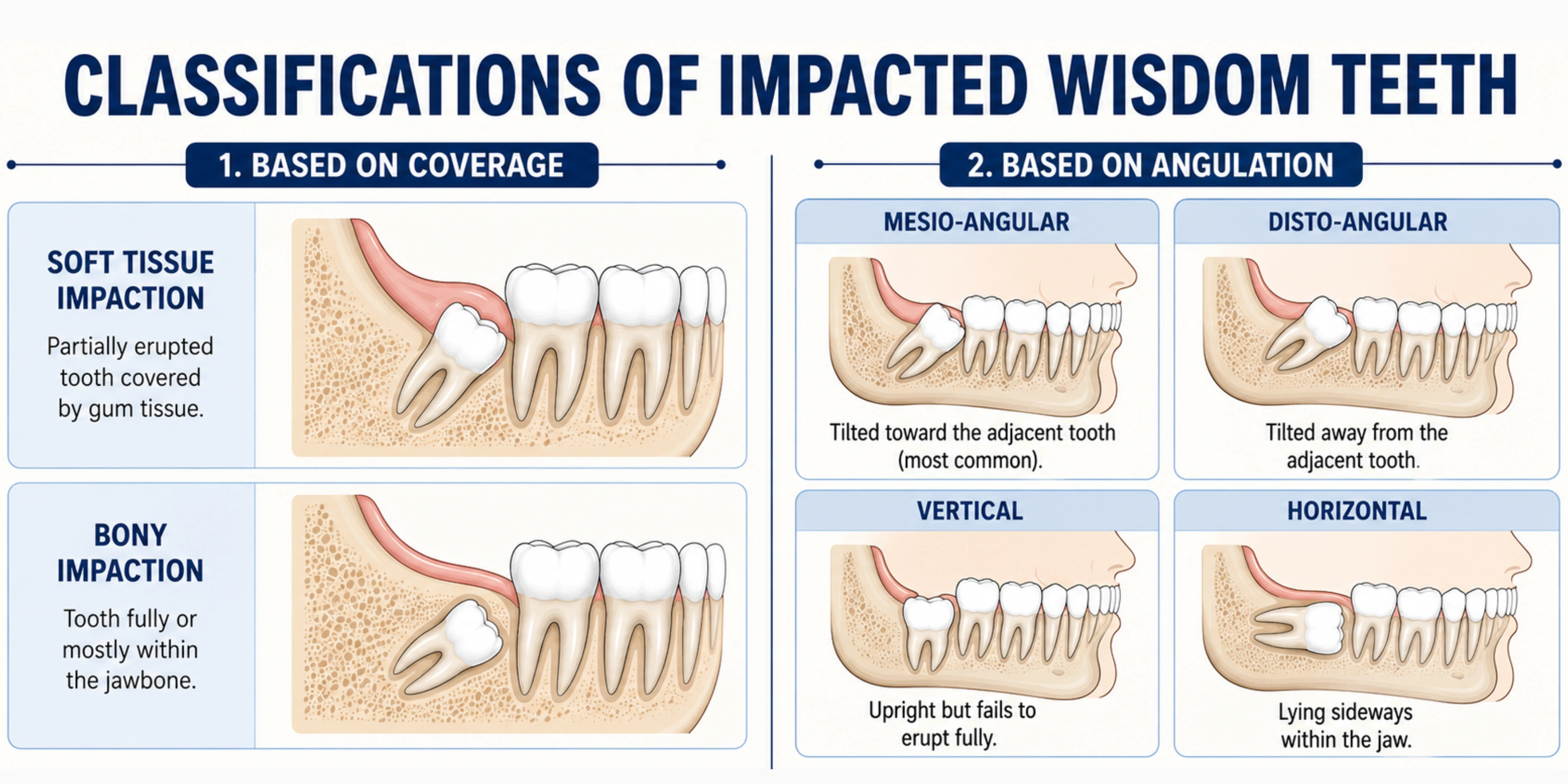 Landscape dental infographic illustrating types of impacted wisdom teeth: soft tissue and bony impaction based on coverage, and four angulations—mesio-angular, disto-angular, vertical, and horizontal—with labeled jaw diagrams.